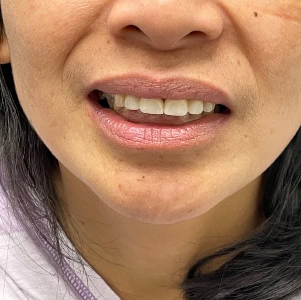 Anterior crowns, after