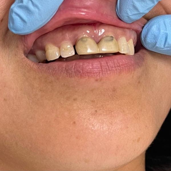 Anterior crowns, before