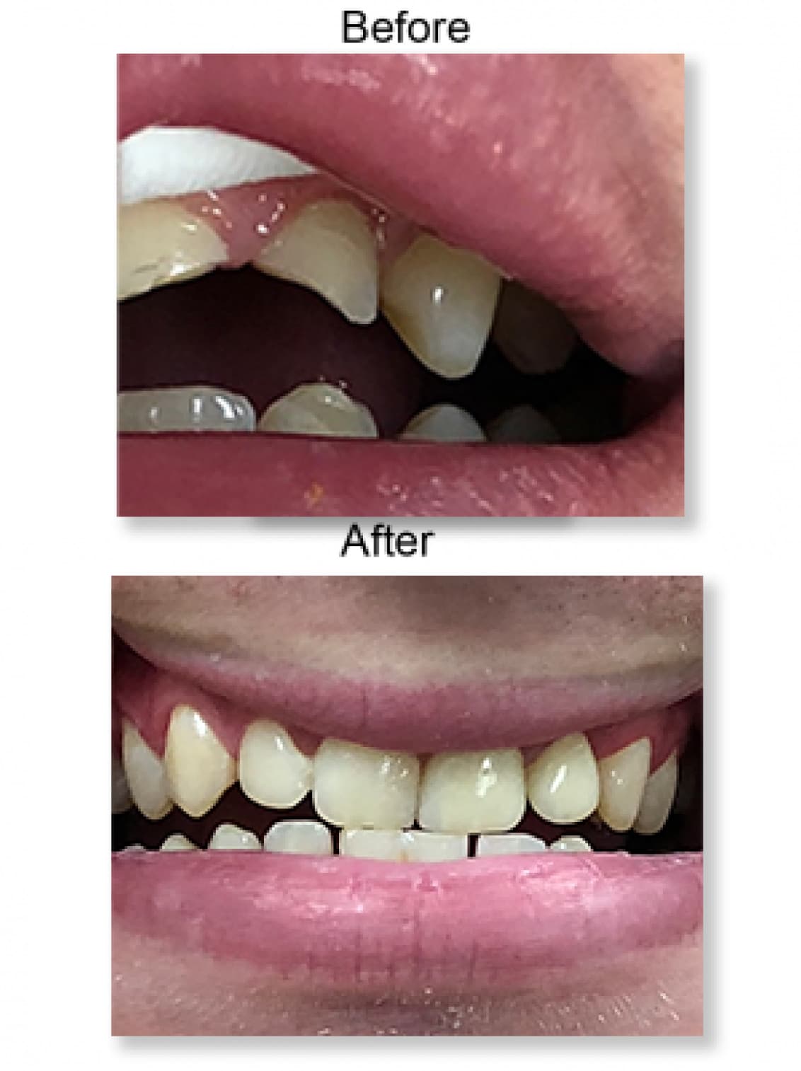 Front teeth restored, before and after