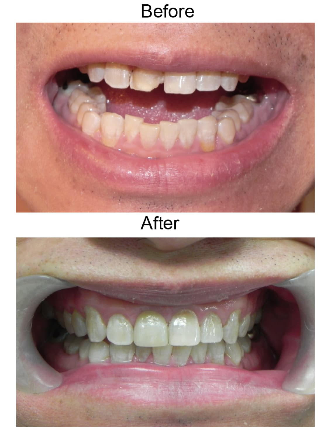 Front tooth veneer, before and after