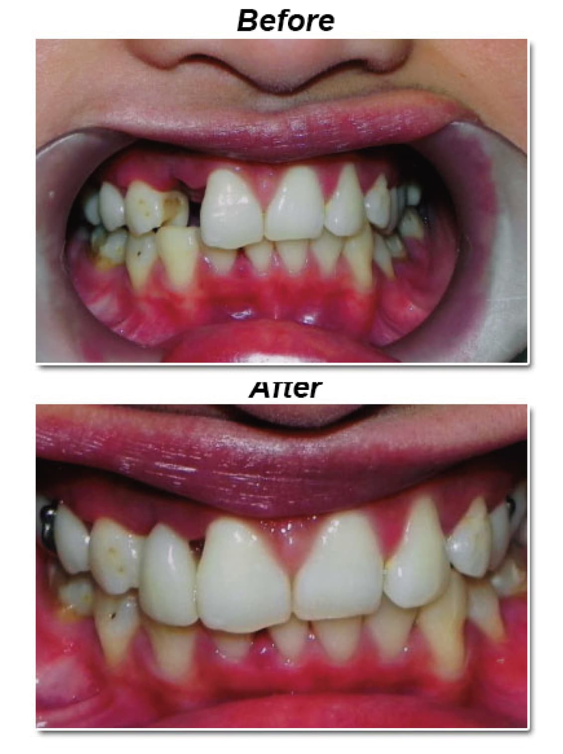 Flipper to replace a missing tooth, before and after