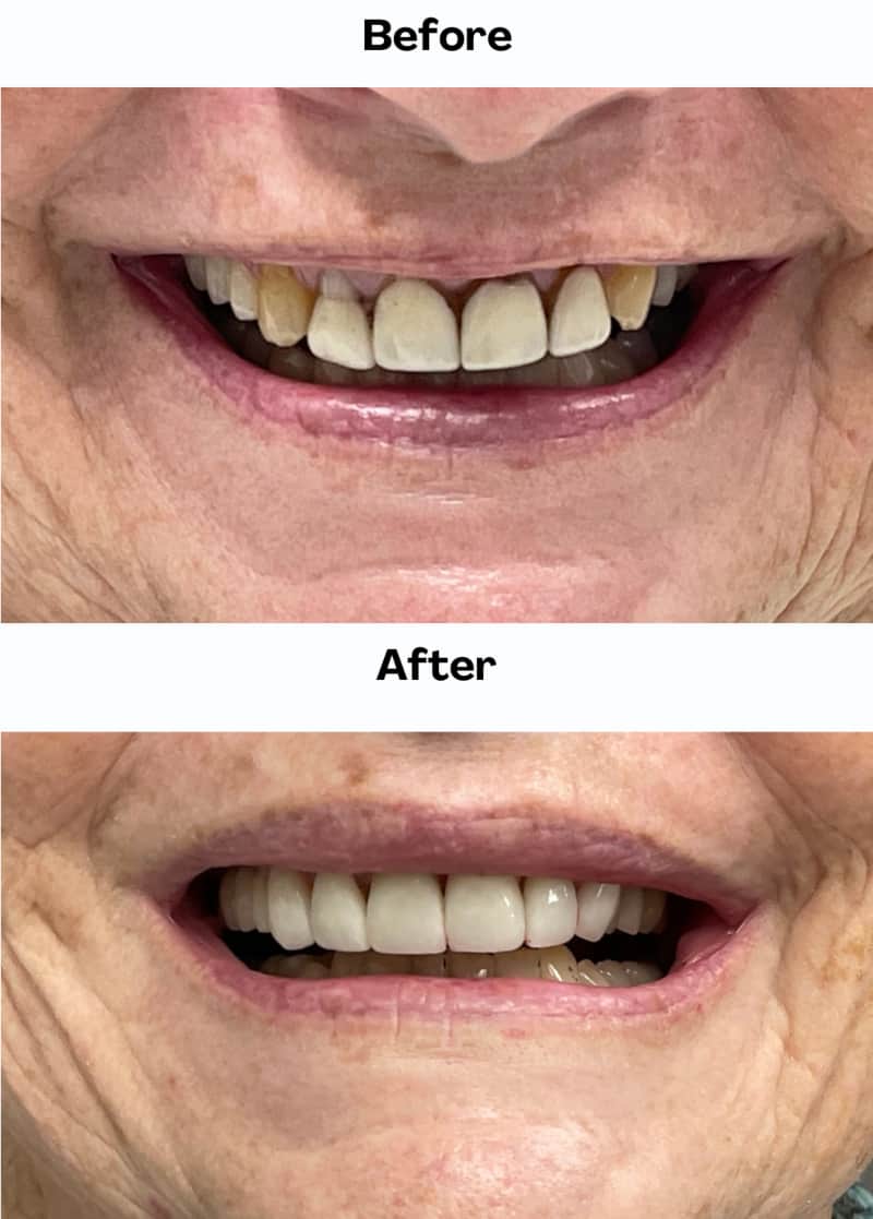 Anterior crowns smile enhancement, before and after