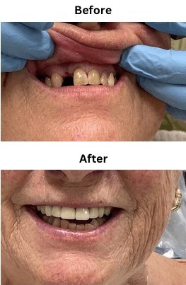 Anterior crown and bridge smile enhancement, before and after