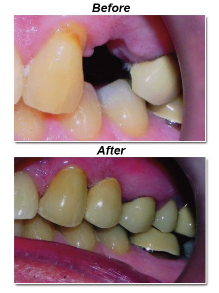 Front teeth restored